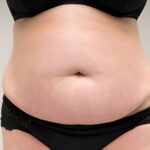 Vitiligo Discoloration Correction: Natural-Looking Results