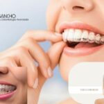 Clinicas dentales Pozuelo Alarcón – Sonrisas con Calidad y Confianza