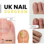Ingrown Toenail Treatment: Fast Relief and Expert Care