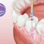 Pròtesis Dental Gines: solucions naturals i duradores