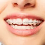 Invisalign Treatment Cost: What to Expect at Dentalign