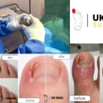 Fungal Nail Birmingham: Fast Relief and Specialist Care