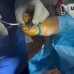 Ingrown Toenails Treatment: Safe, Pain-Free Solutions