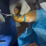 Toenail Removal Near Me: Same-Day Care from Trusted Pros